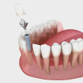 How Dental Implants Can Restore Missing Bicuspids In Dripping Springs