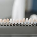 The Benefits Of Replacing Bicuspids With Teeth Implants In Holborn Camden London, W1
