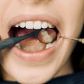 Beyond Brushing: How Edmonds Dentists Can Ensure Optimal Bicuspids Health
