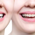 Cracked Or Chipped Bicuspids? Why Immediate Care From An Ashburn Dentist Is Important