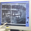 Bicuspids And Orthodontics: How Mansfield Dentists Can Improve Your Smile