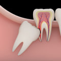 What are Bicuspid Teeth and How Do They Differ from Other Teeth?