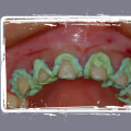 Why Veneer Dentistry In Texas Is The Perfect Solution For Bicuspids