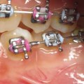 Missing Permanent Teeth: What Are the Special Considerations for Braces with Primary and Permanent Bicuspids?