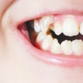 Orthodontic Considerations for Primary and Permanent Bicuspids