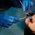 Alternatives To Tooth Removal: Exploring Options For Preserving Bicuspids In Sydney