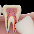 What is the Difference Between a Bicuspid and a Molar Tooth?