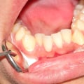 When Your Bicuspids Strike: Handling A Dental Emergency In San Diego