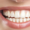 Understanding Bicuspids in Teeth Whitening in Ottawa