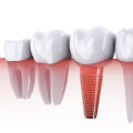 Transform Your Smile With Dental Implants: A Game-Changer For Missing Bicuspids In San Antonio