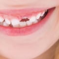 Does the Permanent Dentition Include Total Bicuspids?