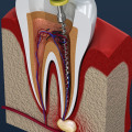 What Happens When a Tooth Infection Reaches the Bone?