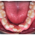 Mixed Dentition Period: When Primary and Permanent Teeth Coexist