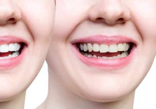 Cracked Or Chipped Bicuspids? Why Immediate Care From An Ashburn Dentist Is Important