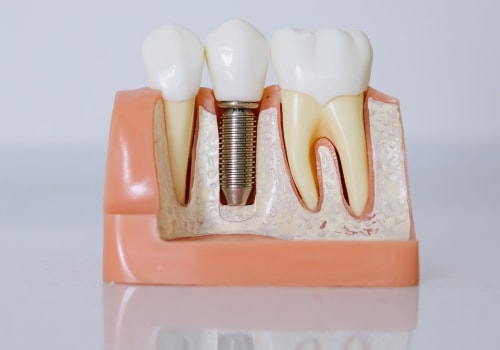 Revitalize Your Smile With Restorative Dentistry Implants In Austin, TX: Bicuspid Edition