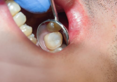Do I Need a Dental Crown After a Root Canal?