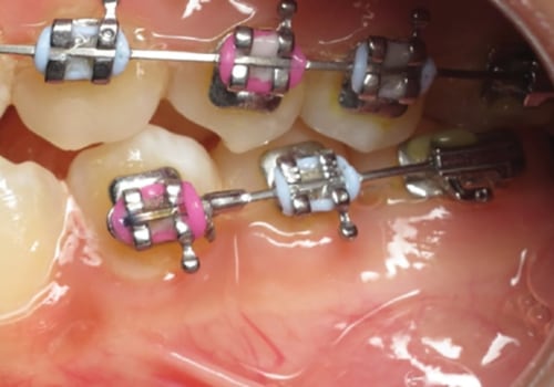 Missing Permanent Teeth: What Are the Special Considerations for Braces with Primary and Permanent Bicuspids?