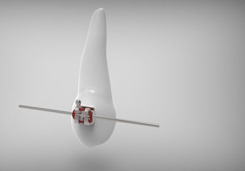 Understanding Bicuspids and Braces: Expert Orthodontic Care in Fort Walton Beach