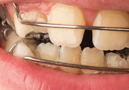 Mixed Dentition: Understanding the Combination of Primary and Permanent Teeth