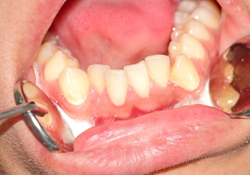 When Your Bicuspids Strike: Handling A Dental Emergency In San Diego