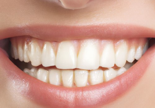 Understanding Bicuspids in Teeth Whitening in Ottawa