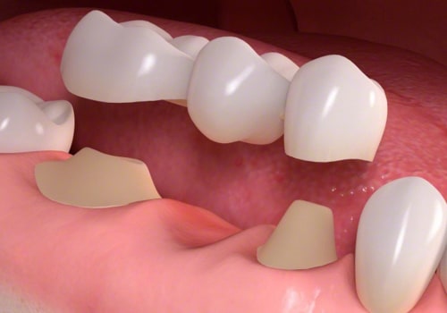 Cleaning and Maintaining Primary and Permanent Bicuspids: A Comprehensive Guide